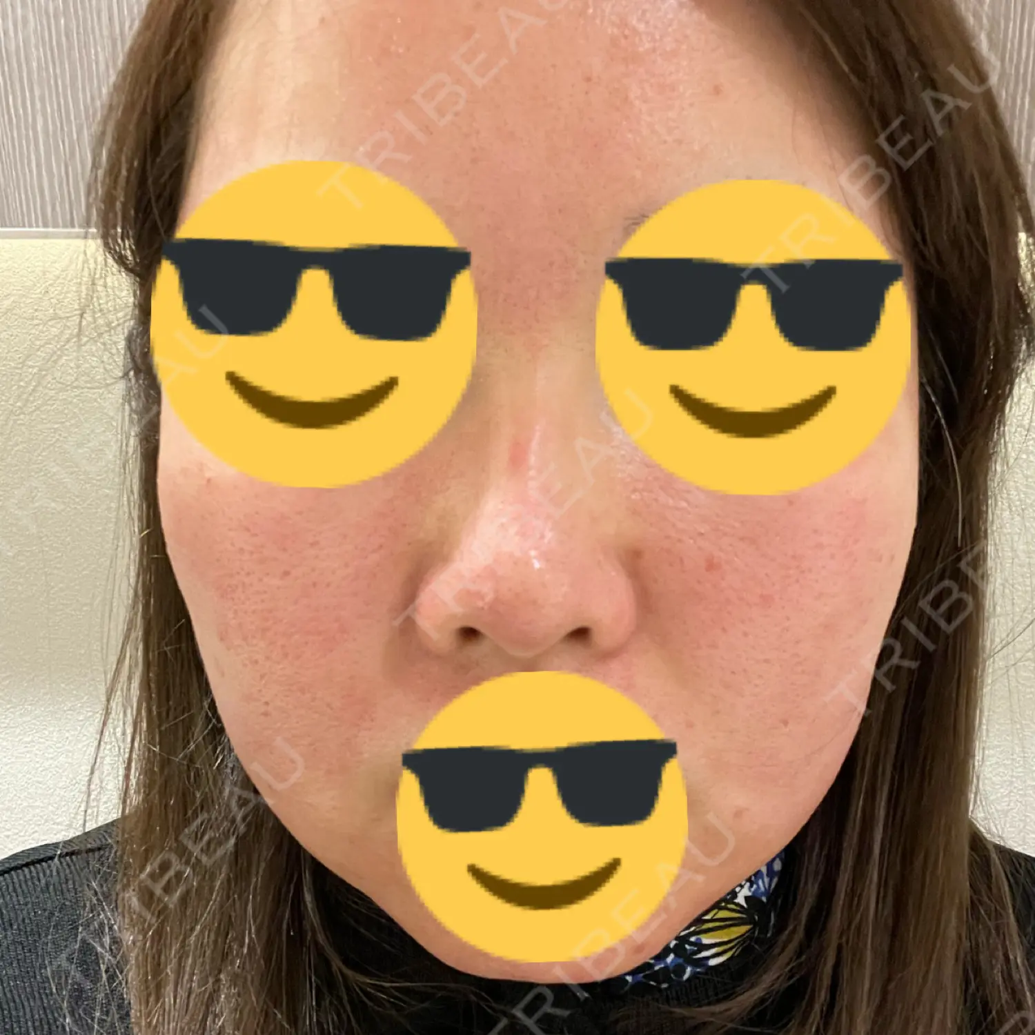 施術後の写真
