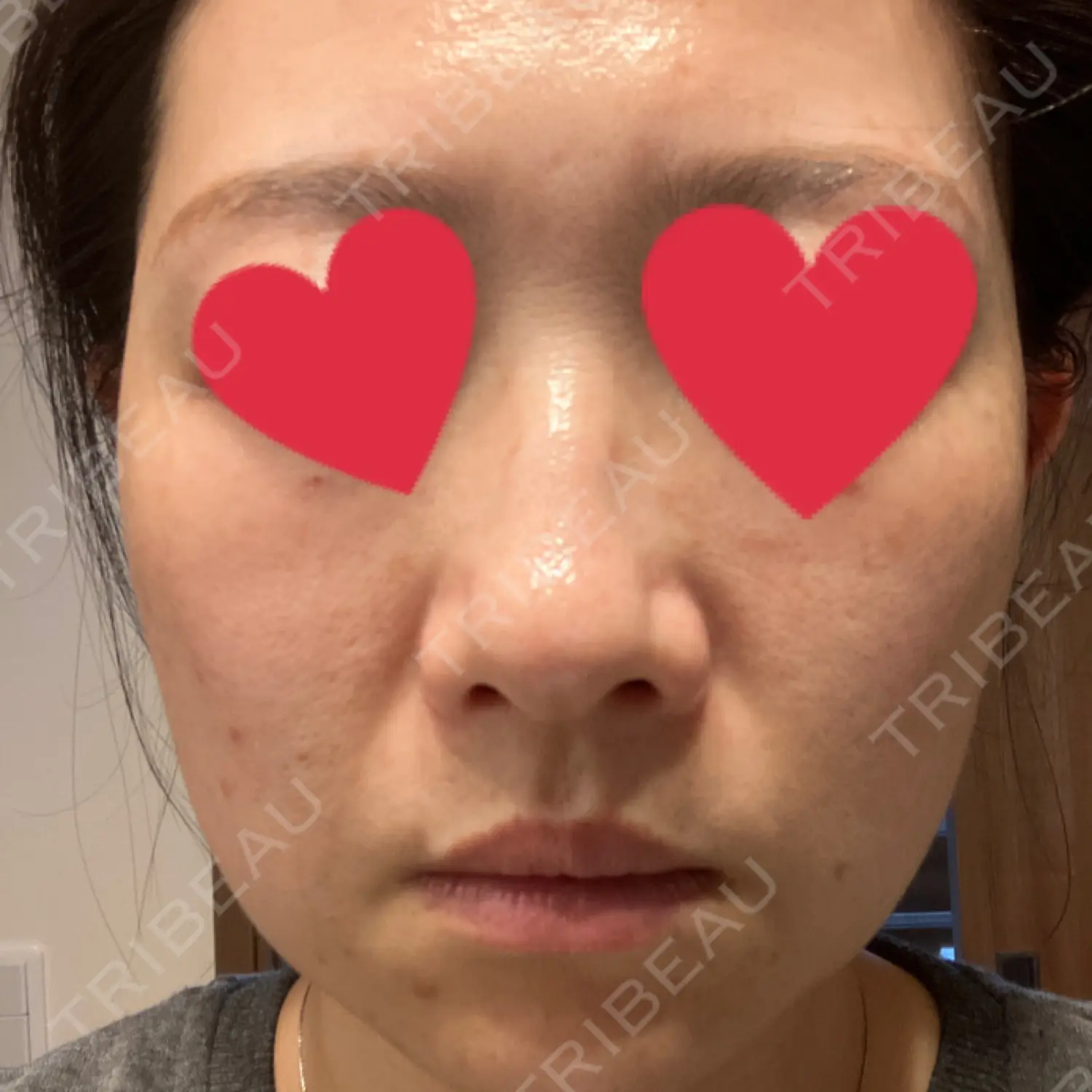 施術後の写真