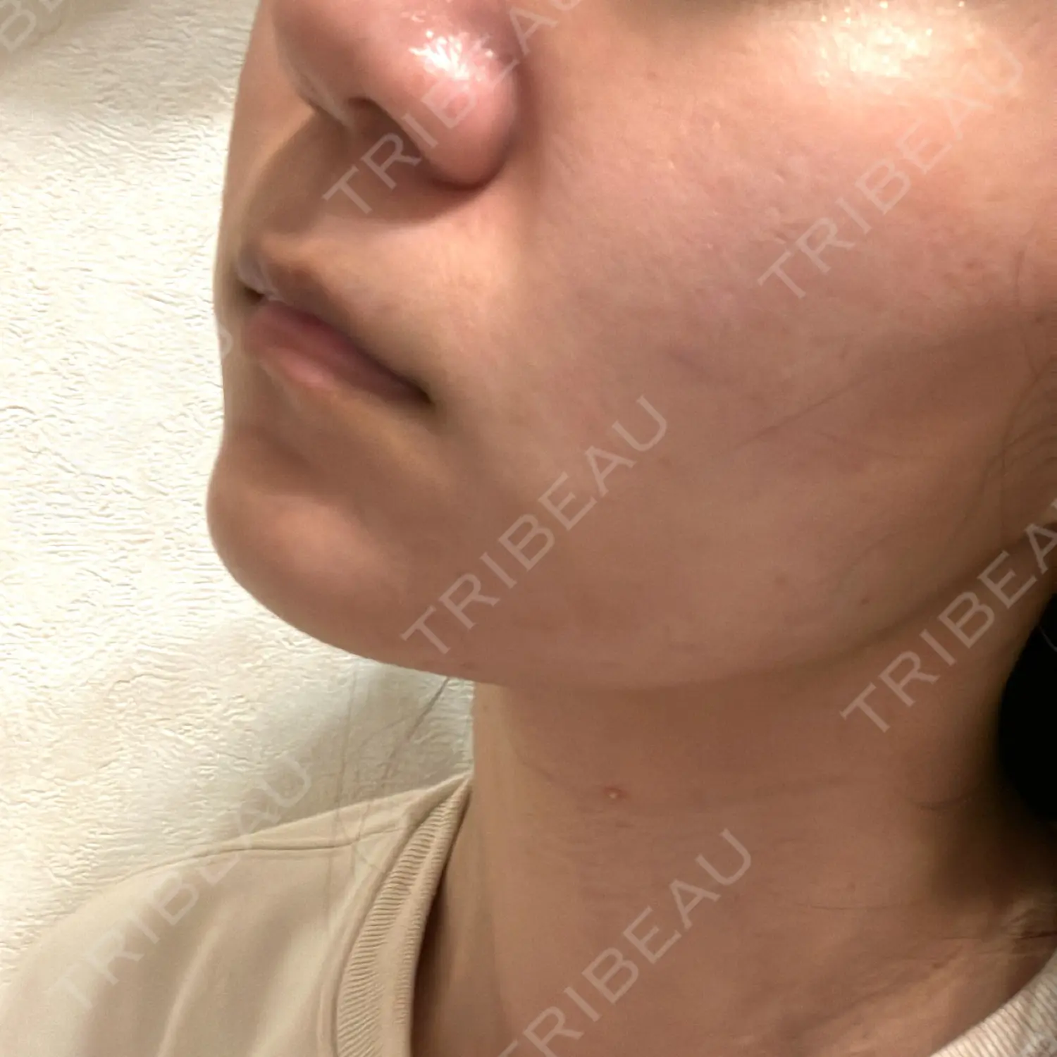 施術後の写真