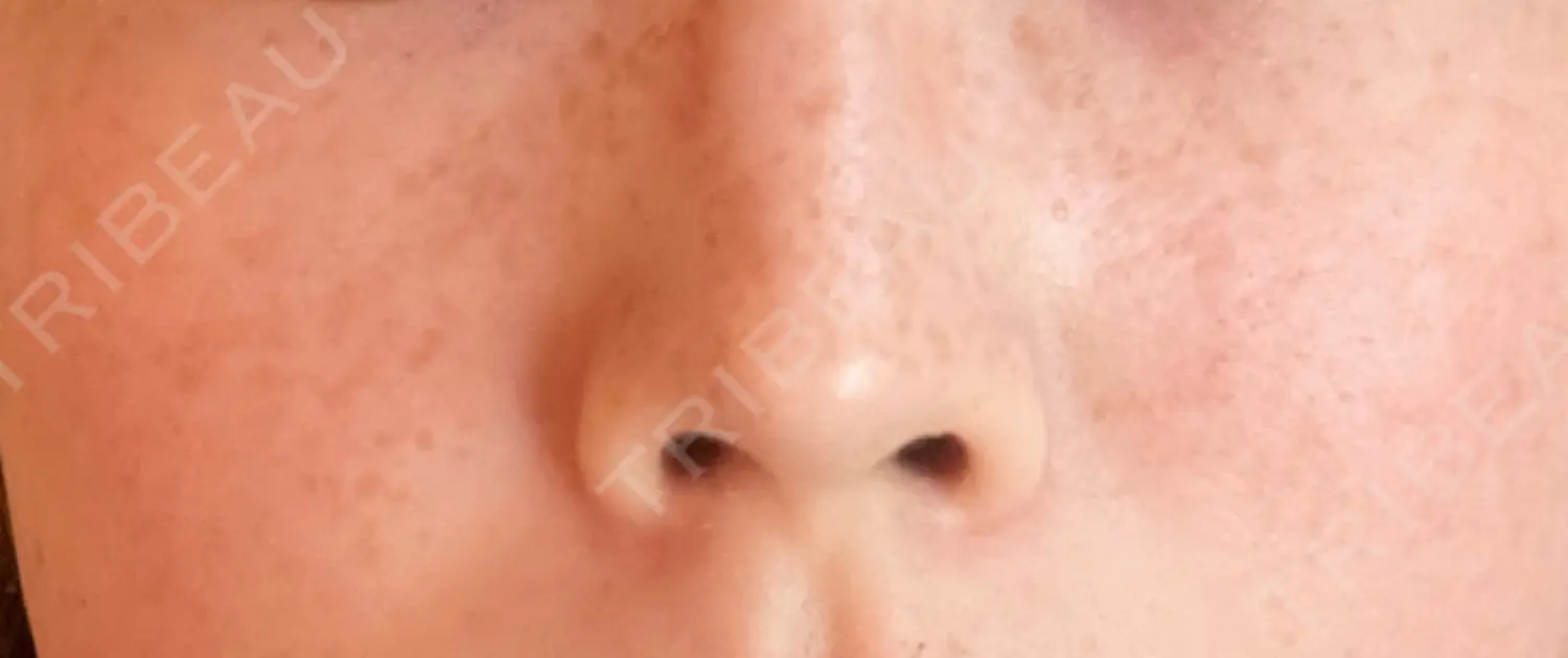 施術後の写真