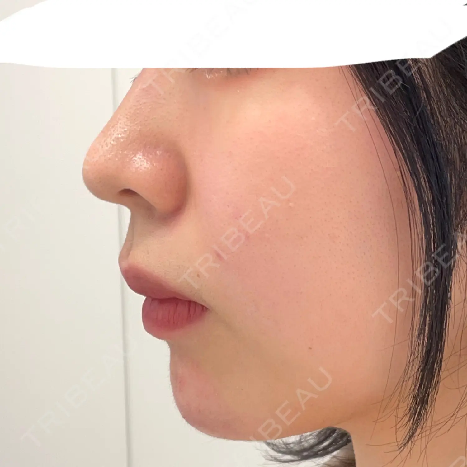 施術後の写真