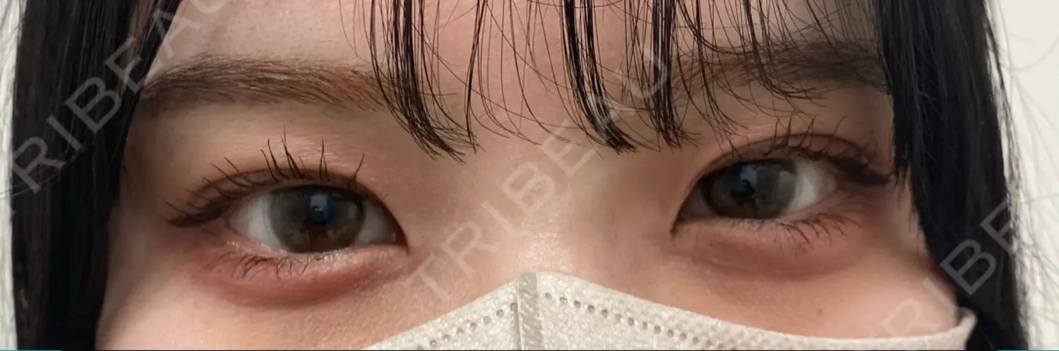 施術後の写真