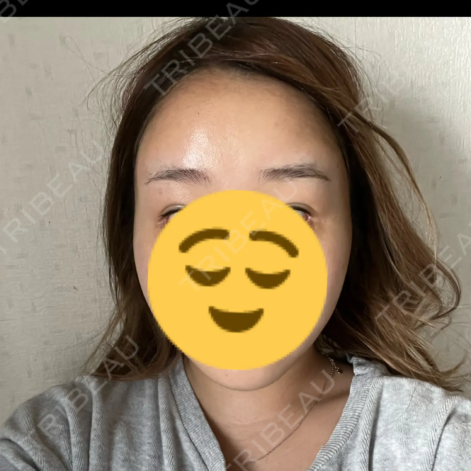 施術後の写真