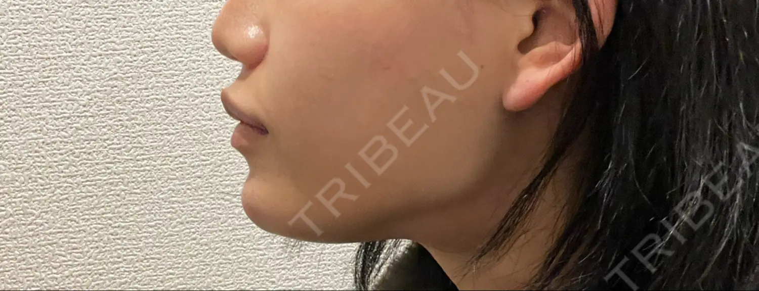 施術後の写真