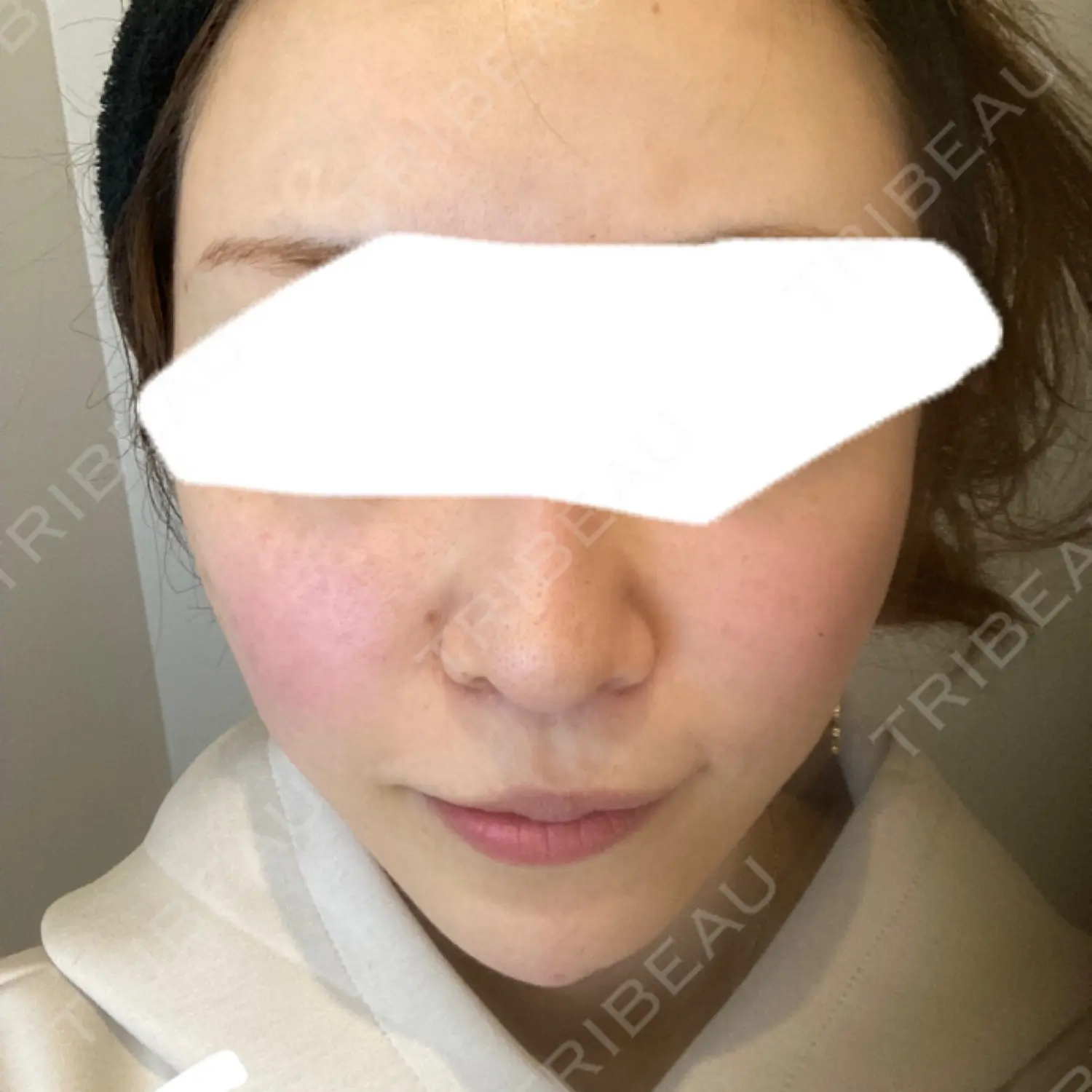 施術後の写真