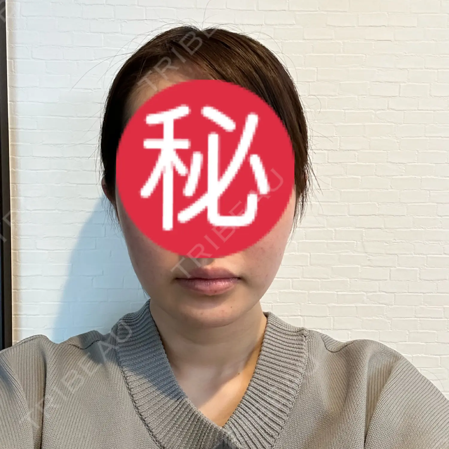 施術後の写真