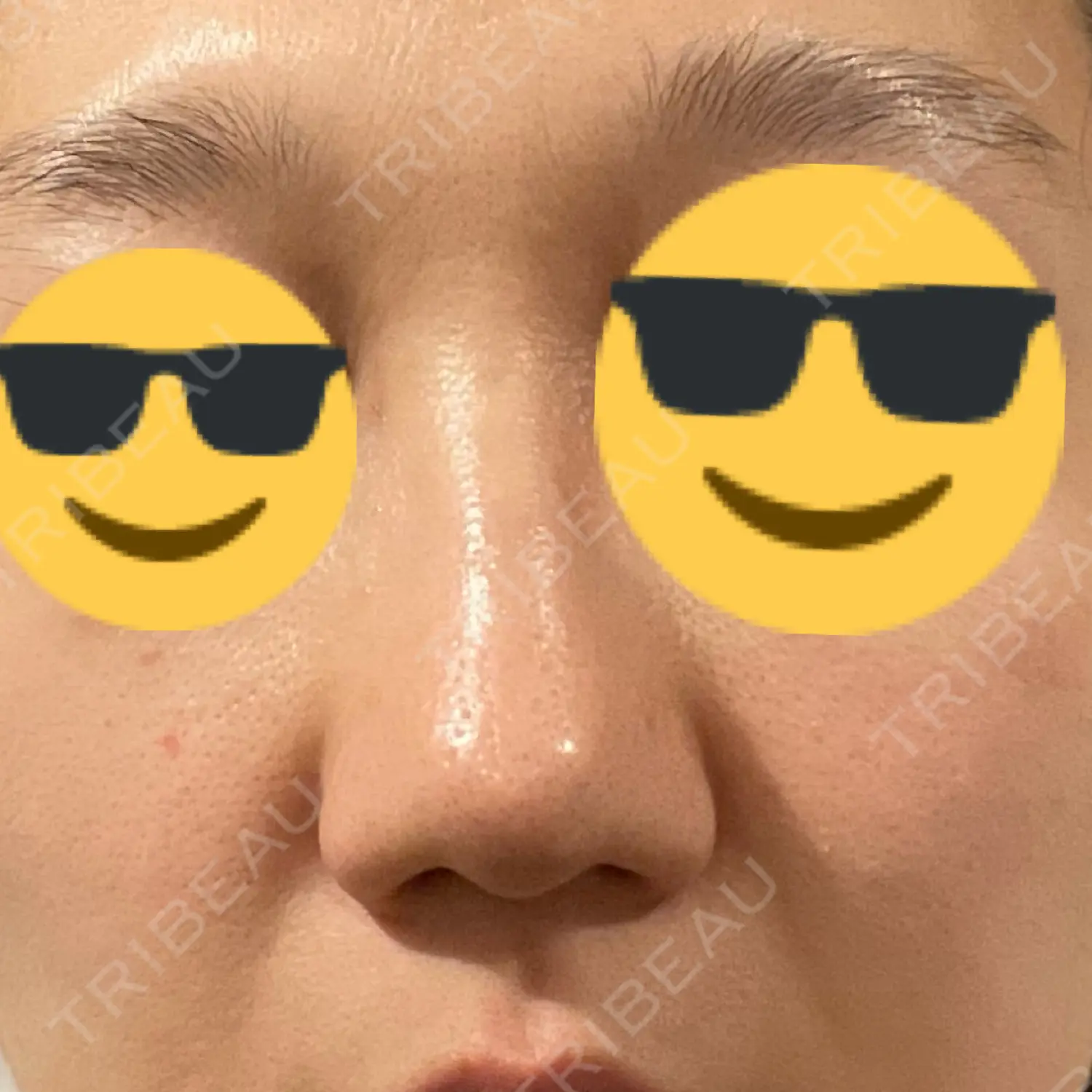 施術後の写真