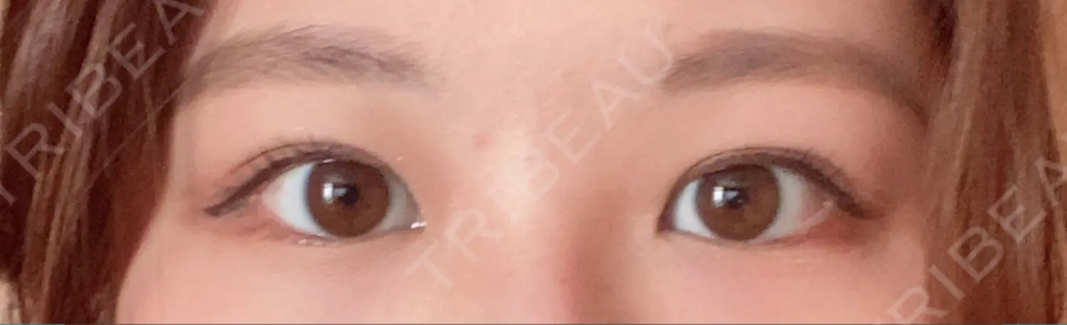 施術後の写真