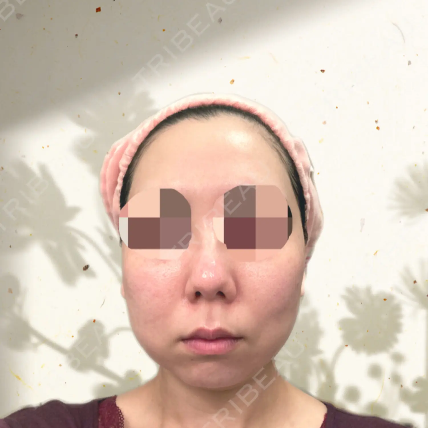 施術後の写真