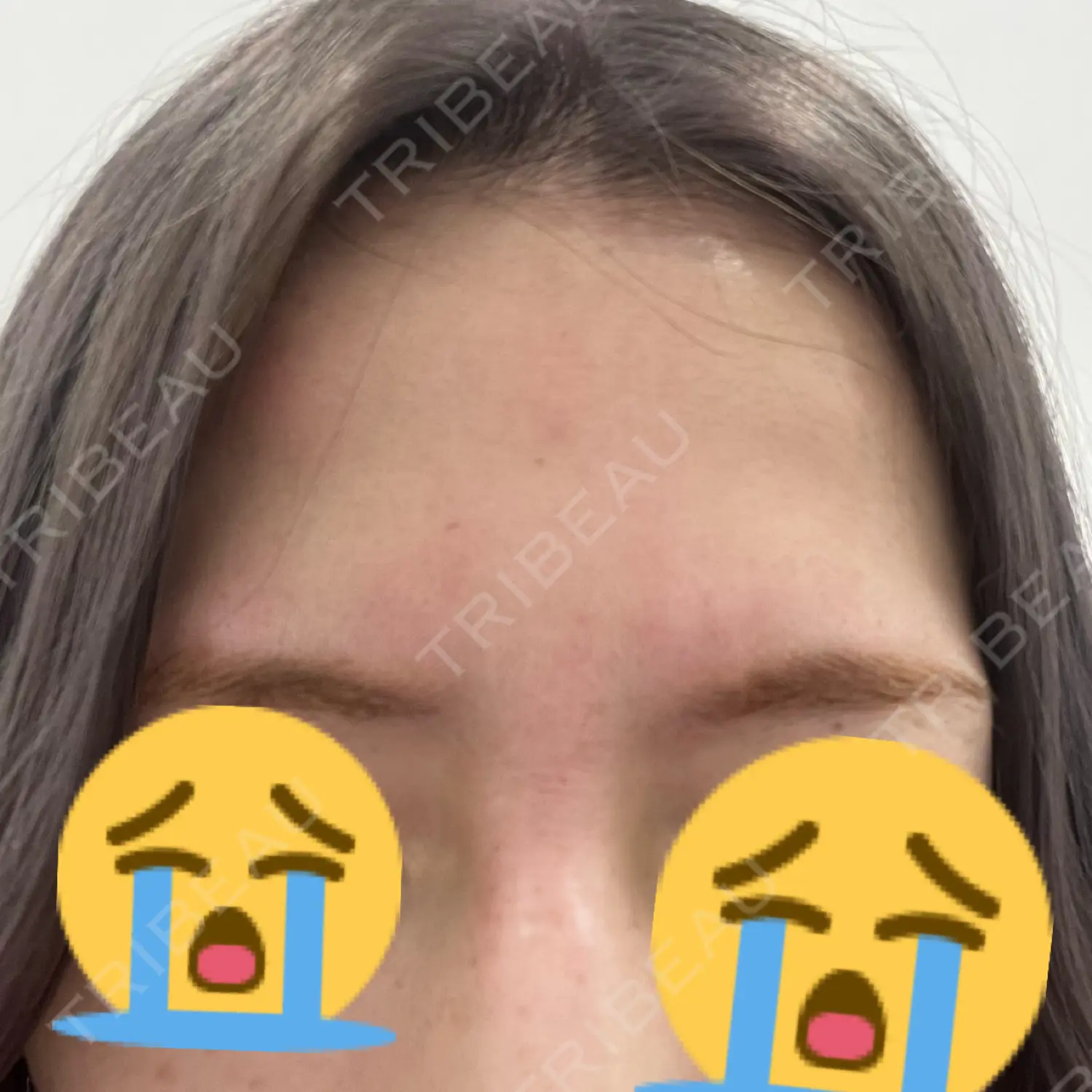 施術後の写真