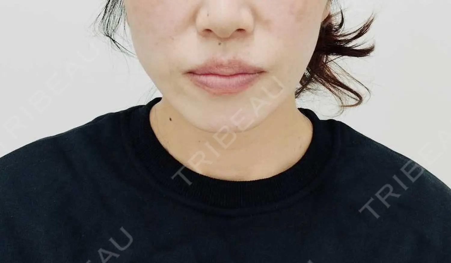 施術後の写真