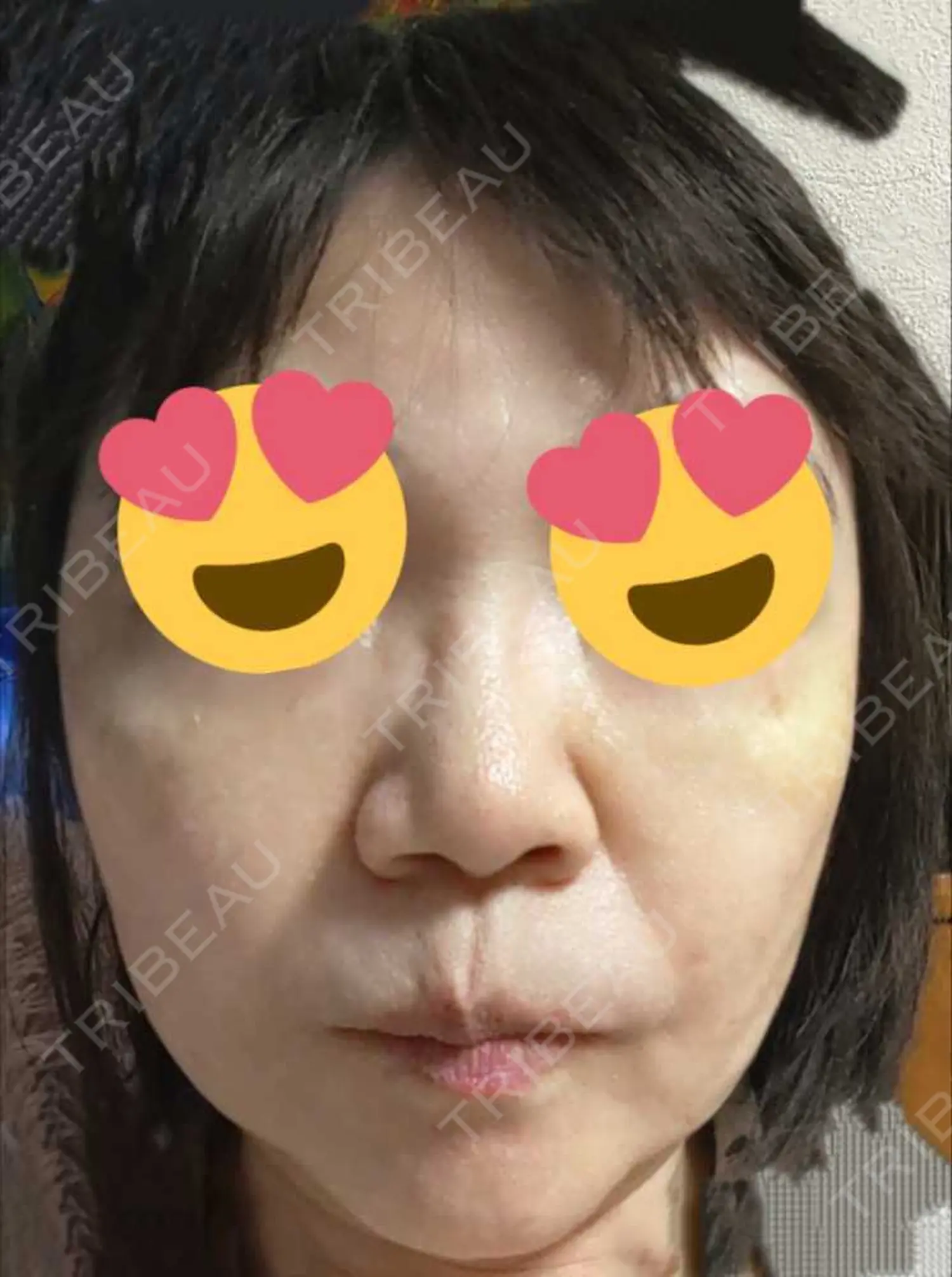 施術後の写真