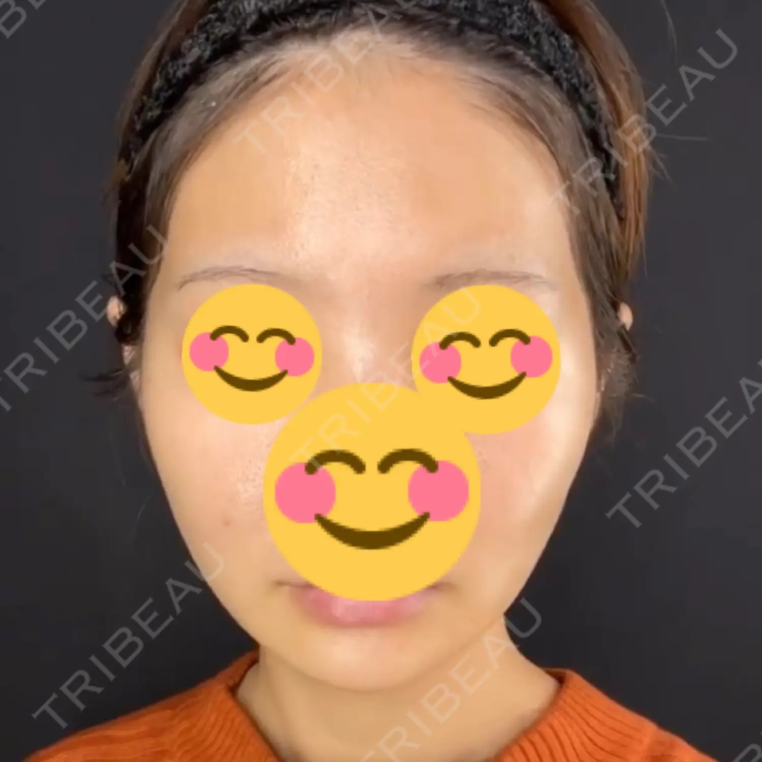 施術後の写真