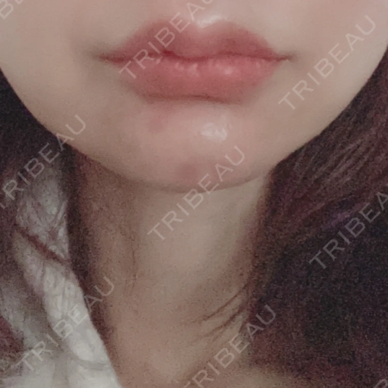 施術後の写真
