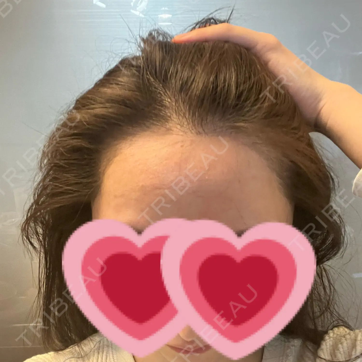 施術後の写真