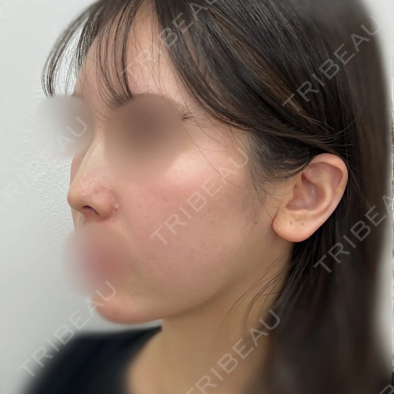施術後の写真