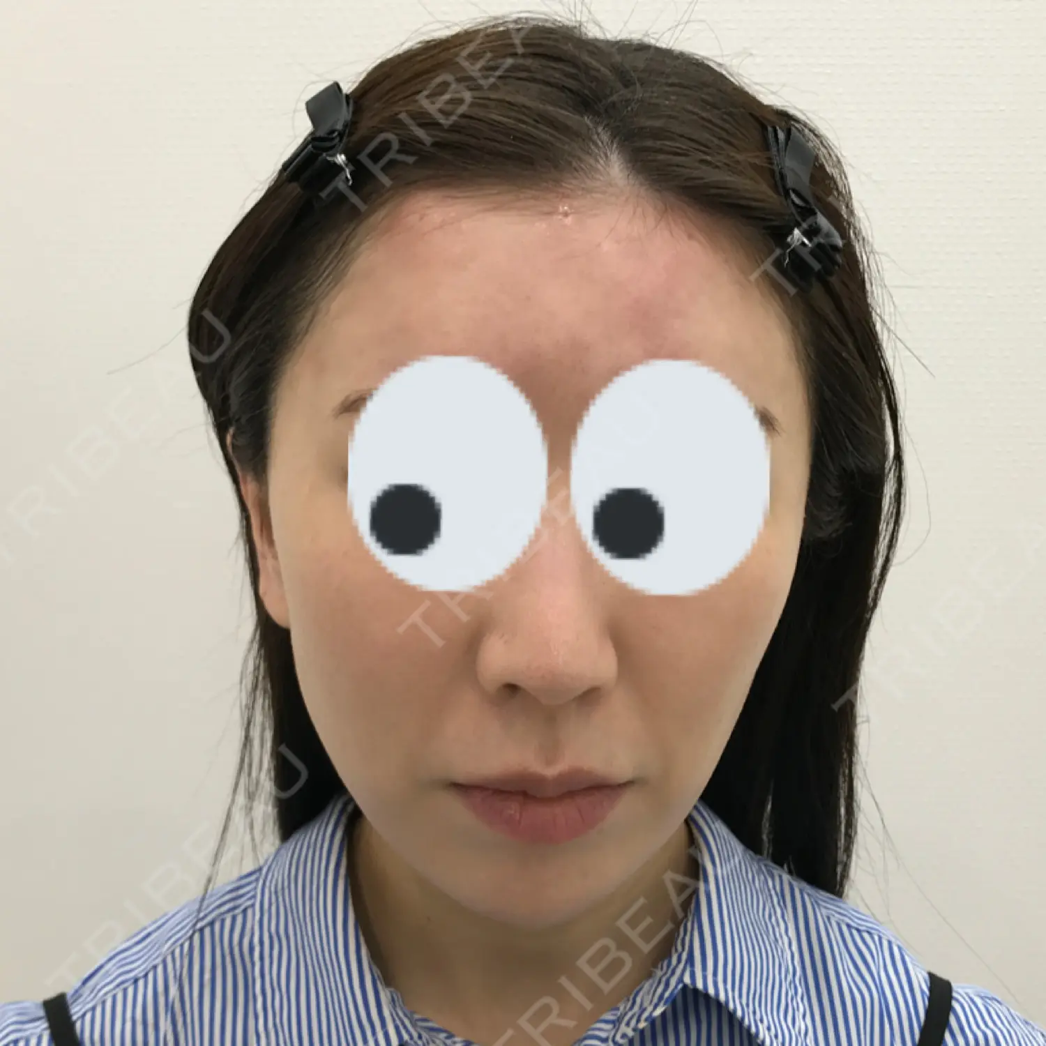 施術後の写真
