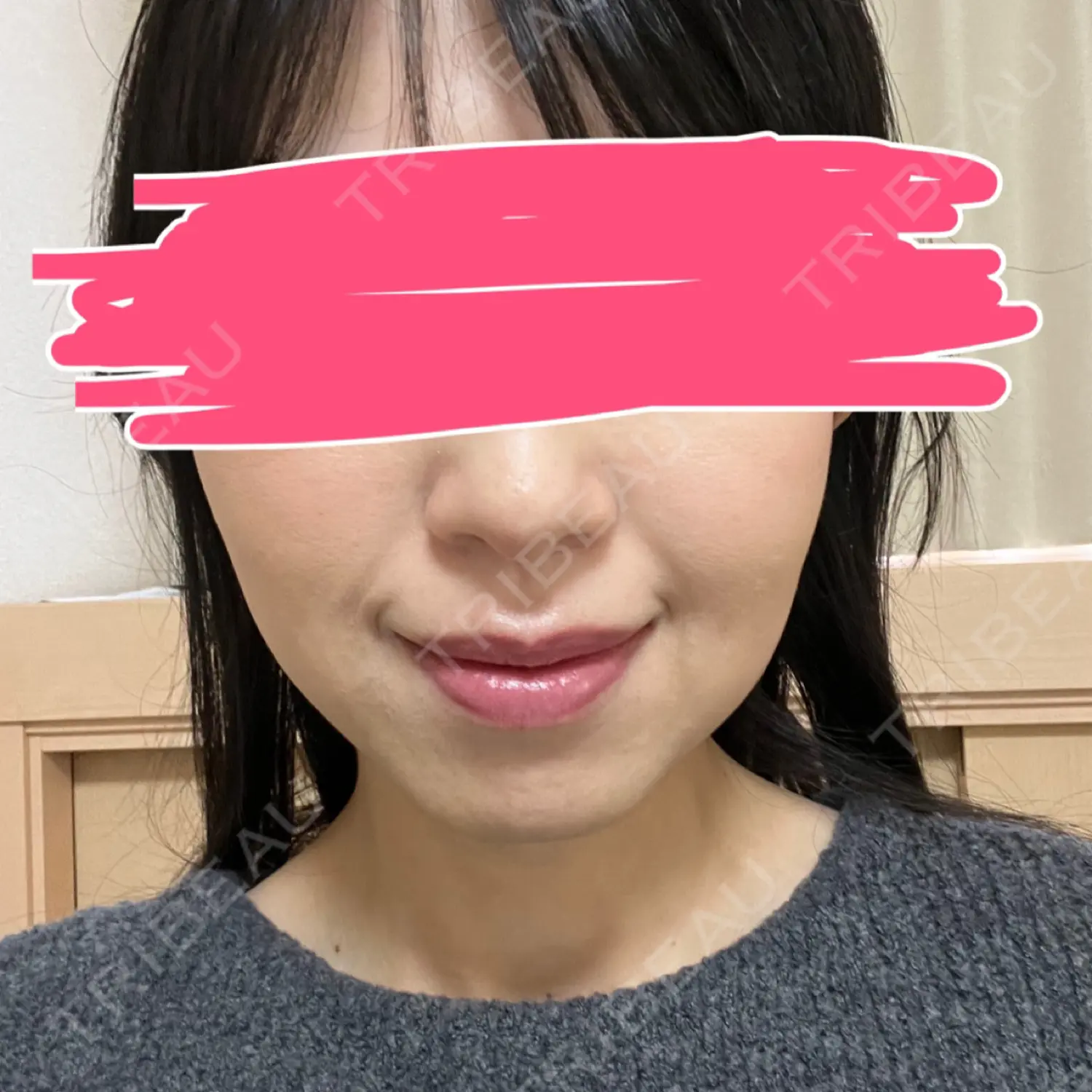 施術後の写真