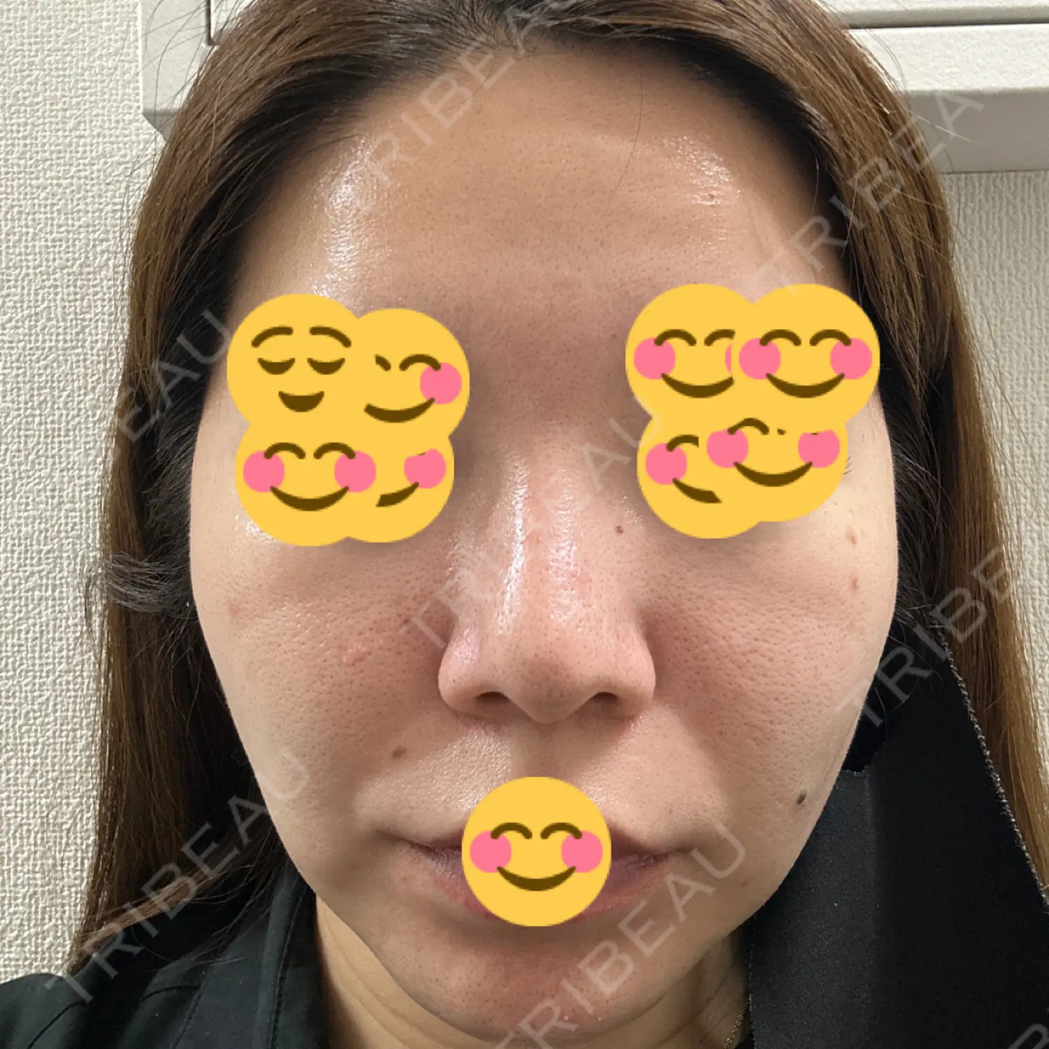 施術後の写真