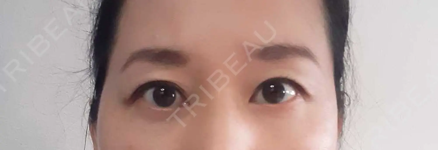 施術後の写真