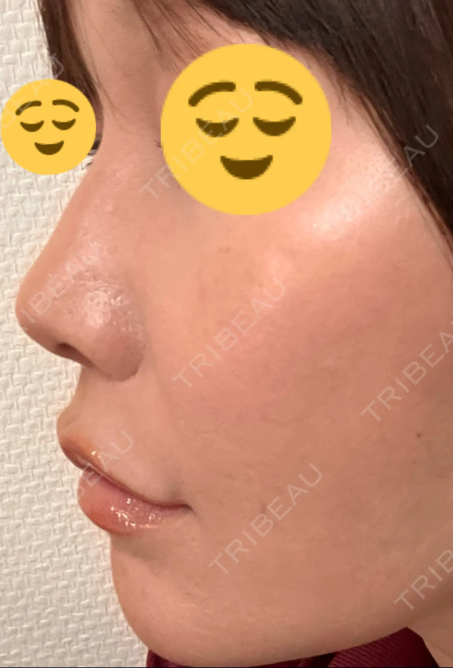 施術後の写真