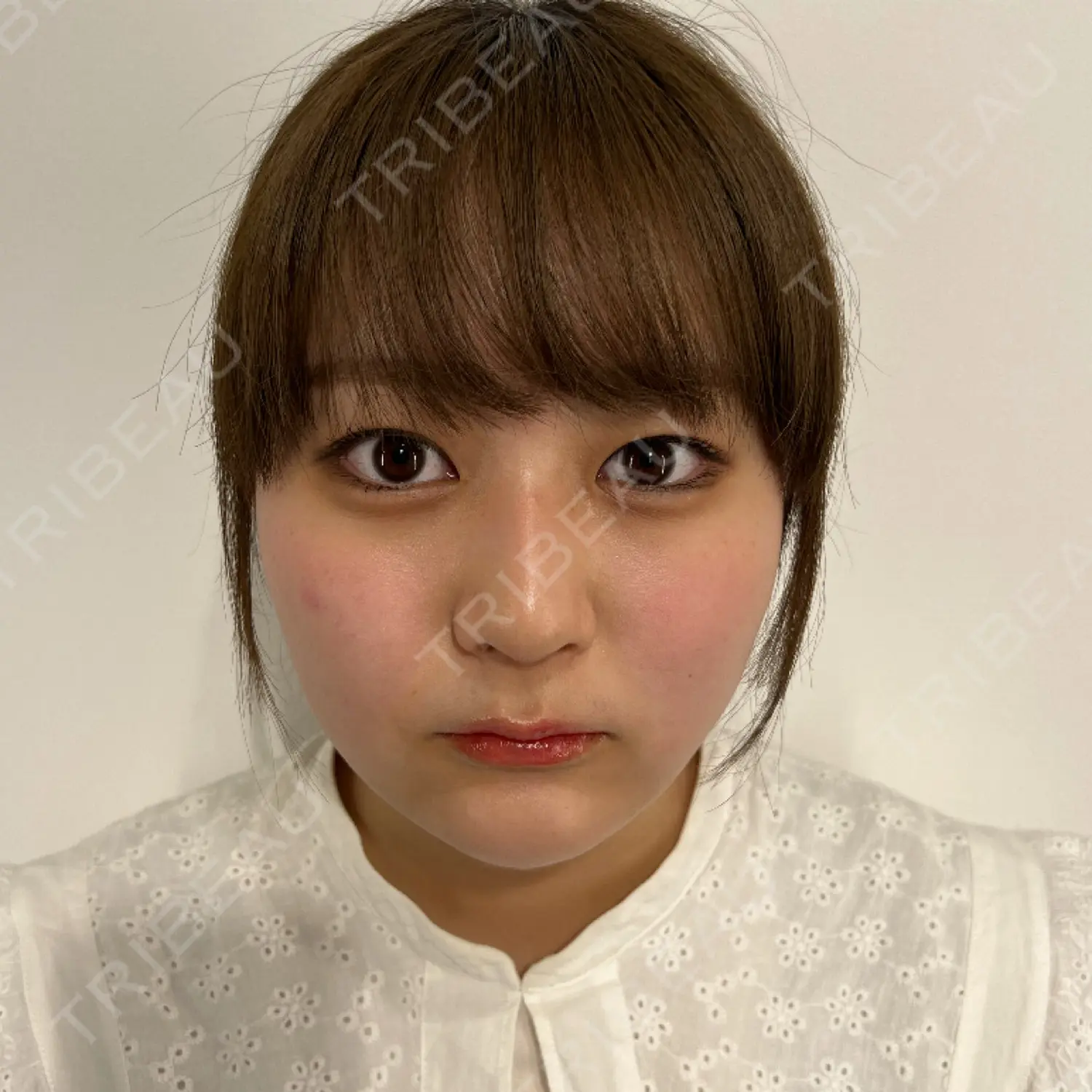 施術後の写真