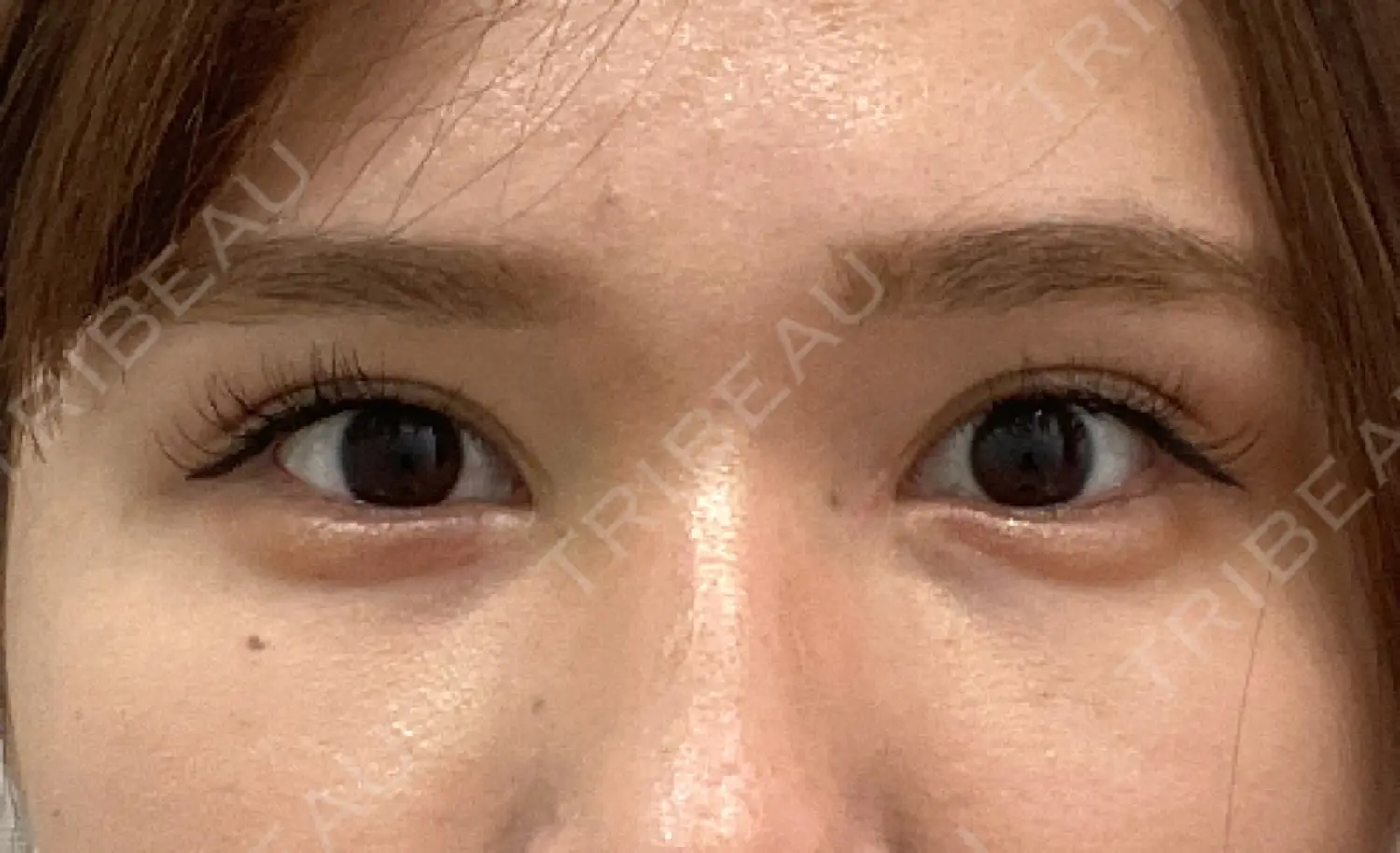 施術後の写真