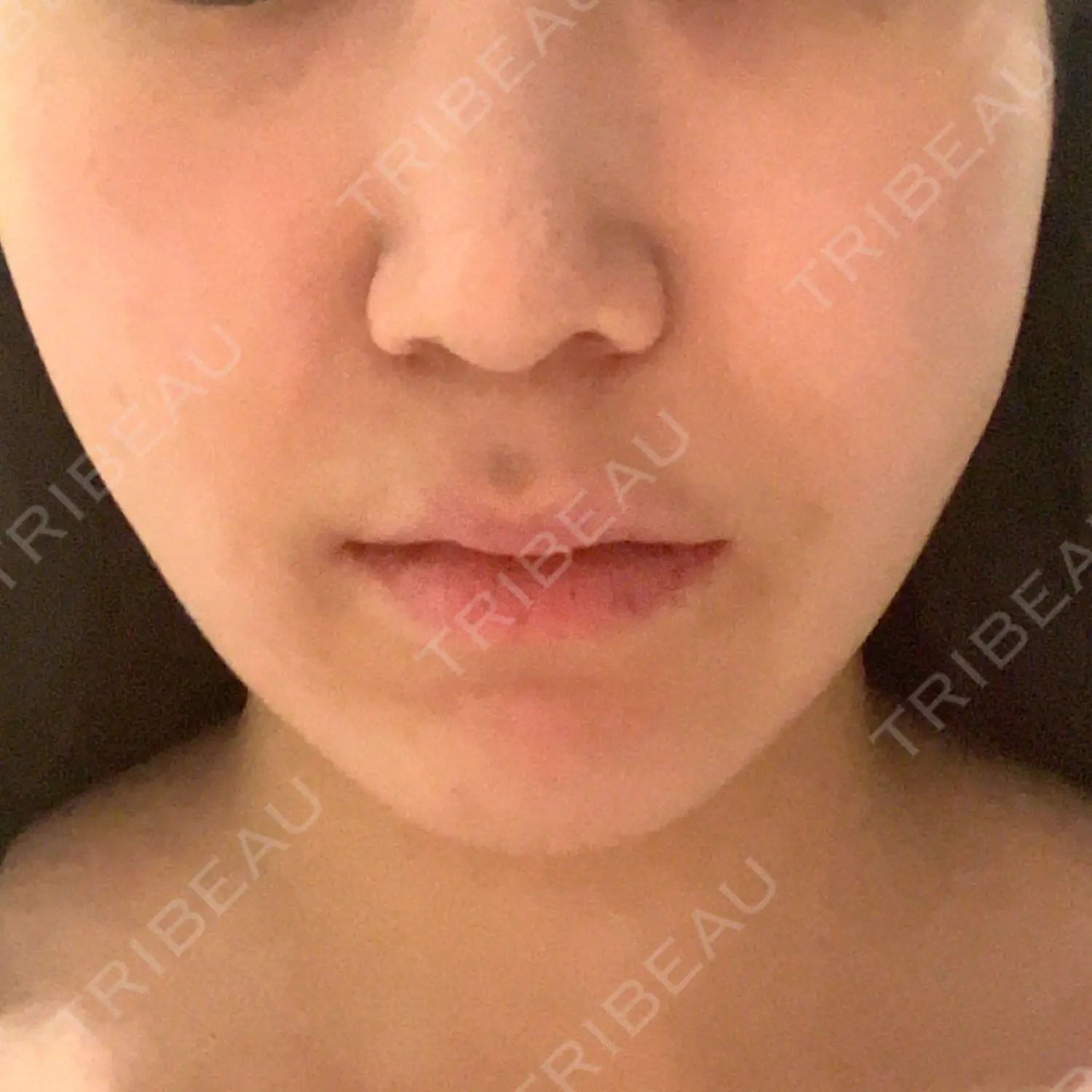 施術後の写真