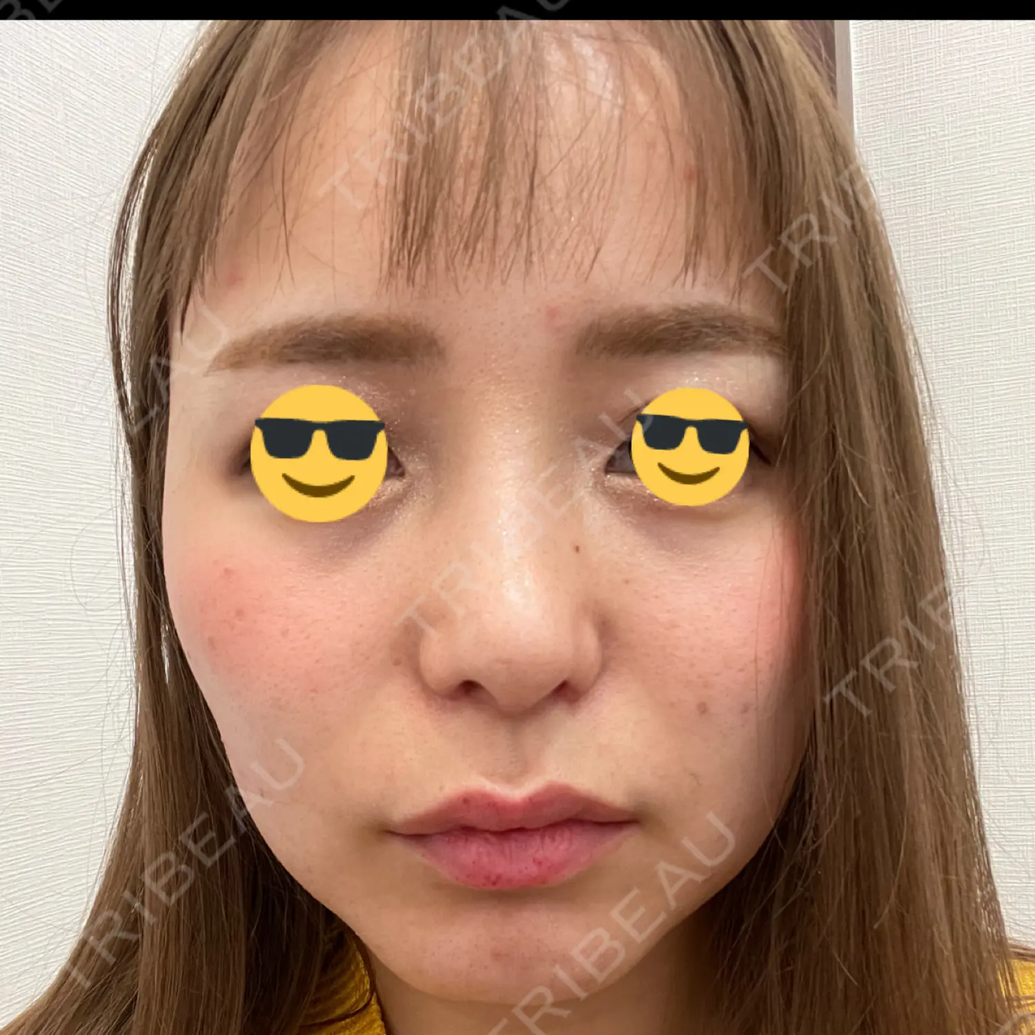 施術後の写真