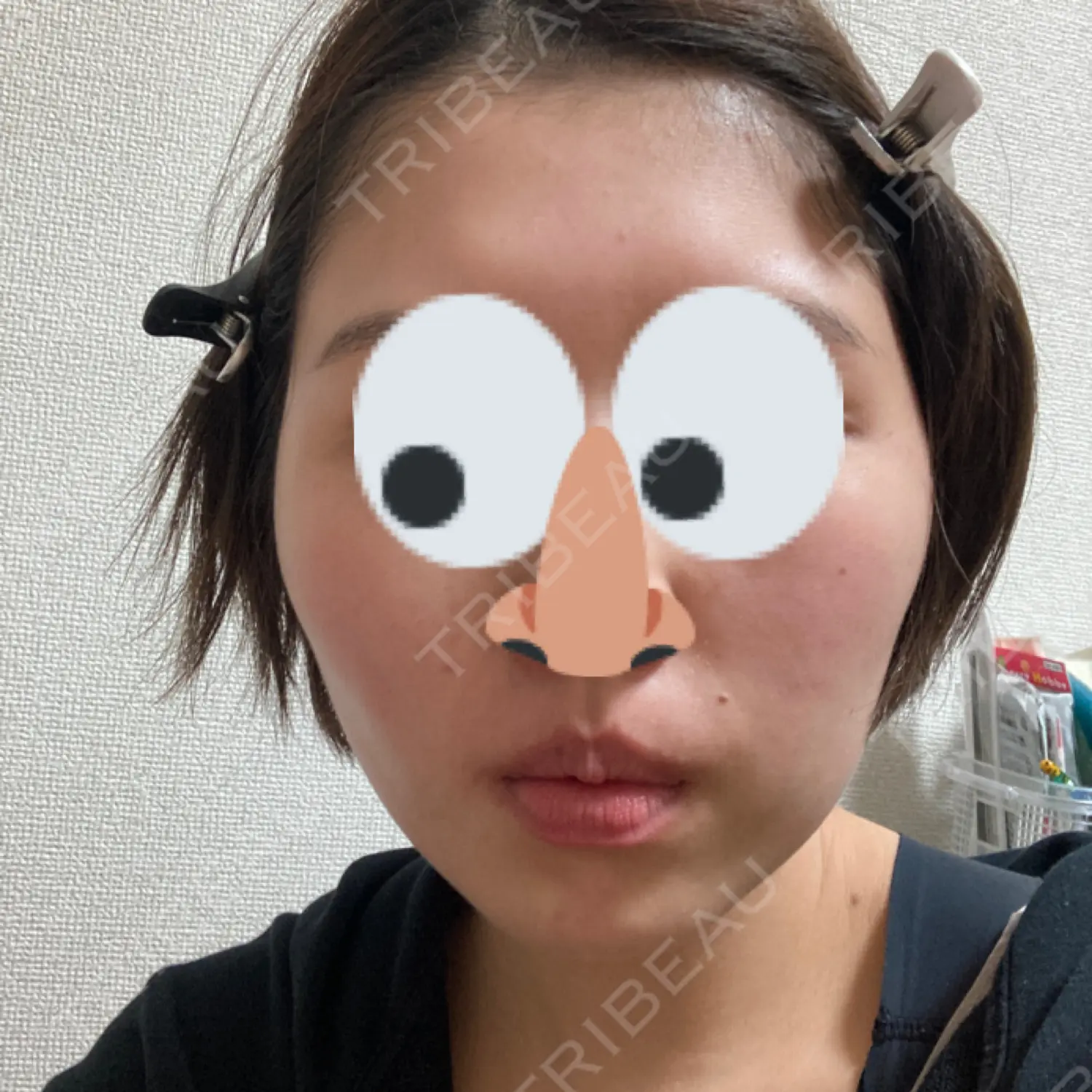 施術後の写真