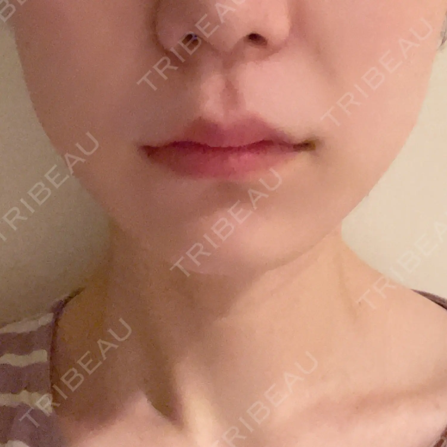 施術後の写真