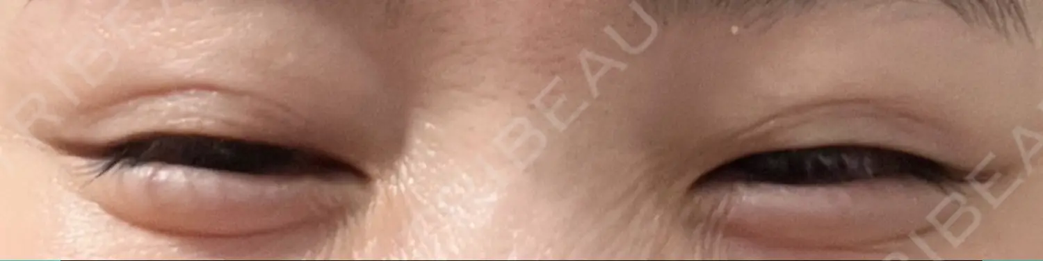 施術後の写真