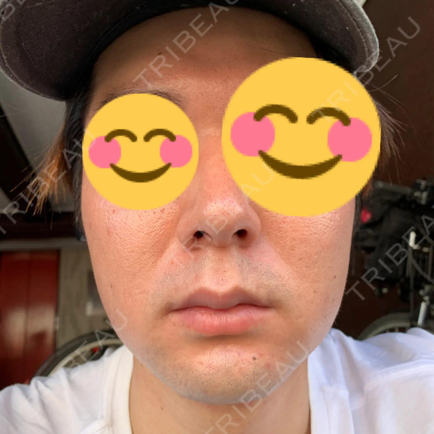 施術後の写真