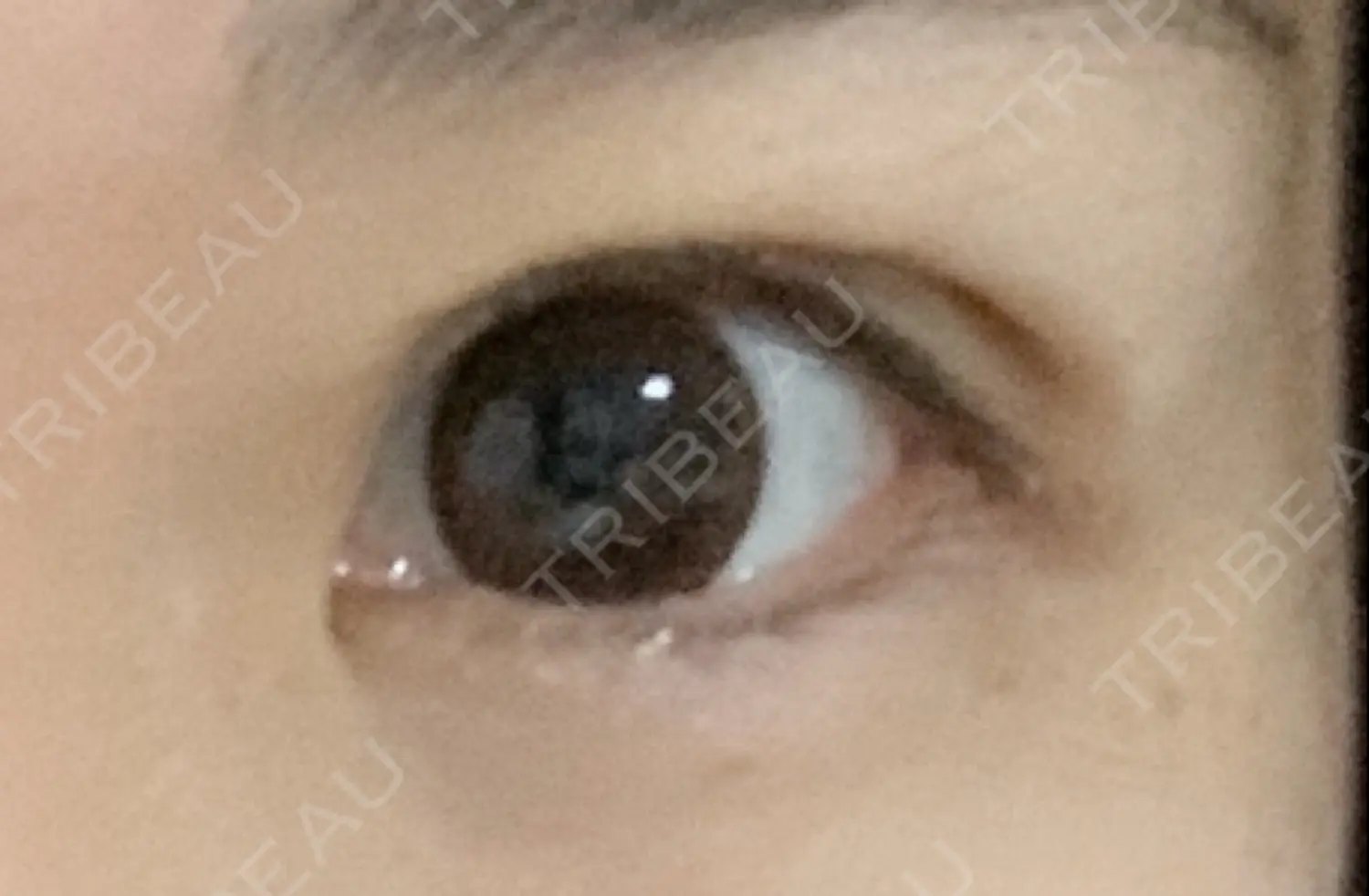施術後の写真