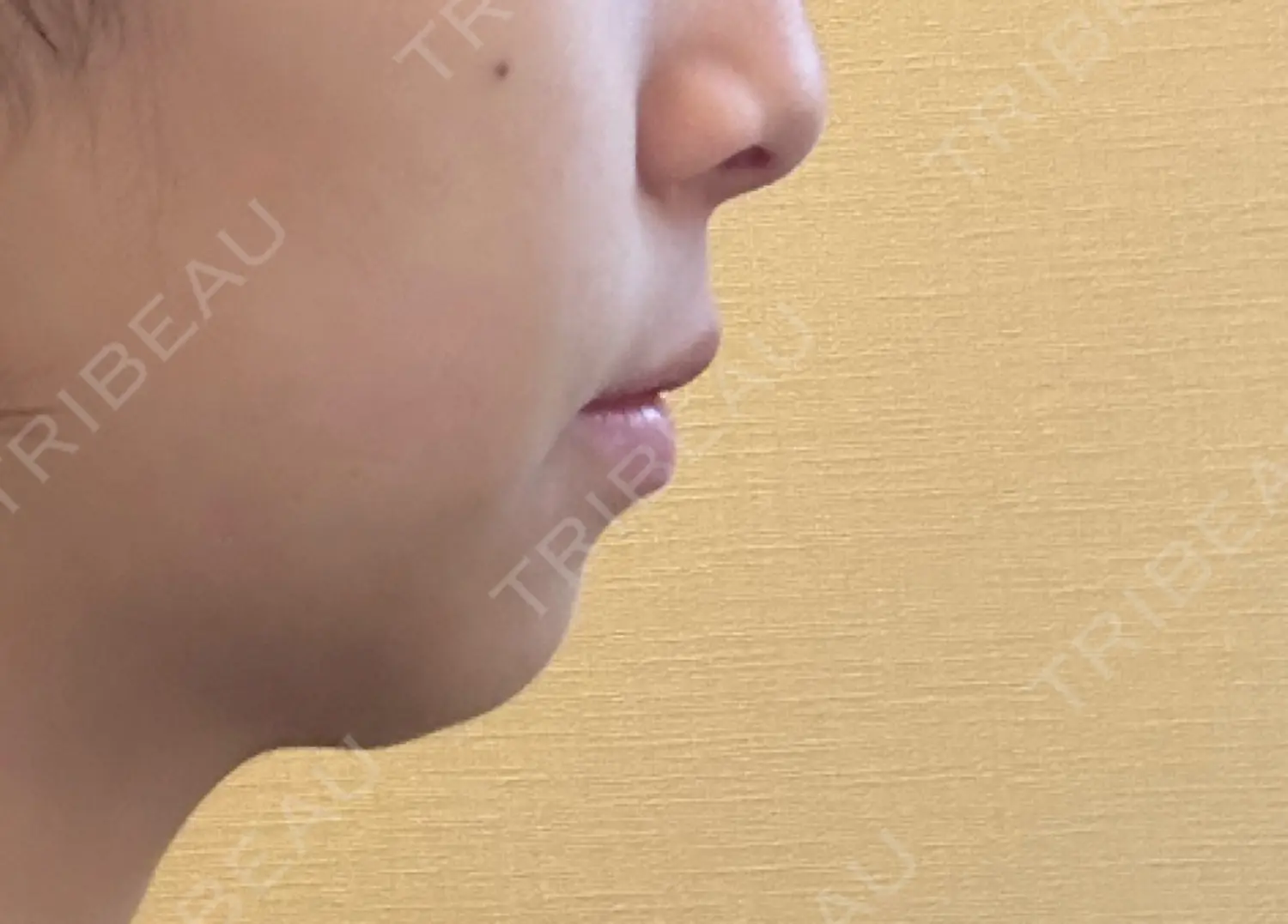 施術後の写真