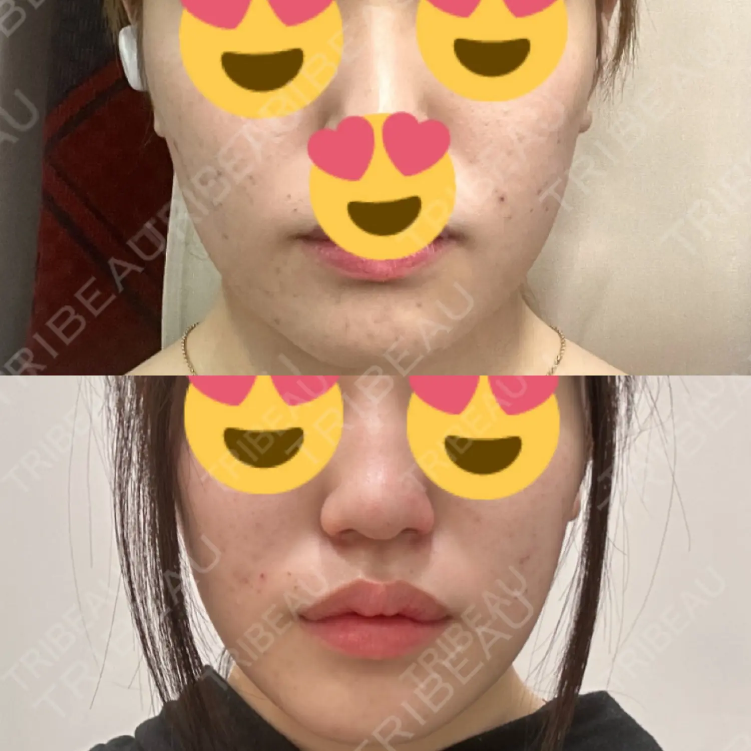 施術後の写真