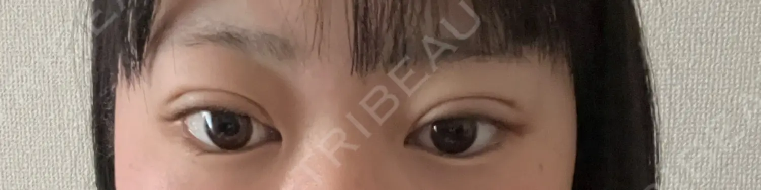 施術後の写真