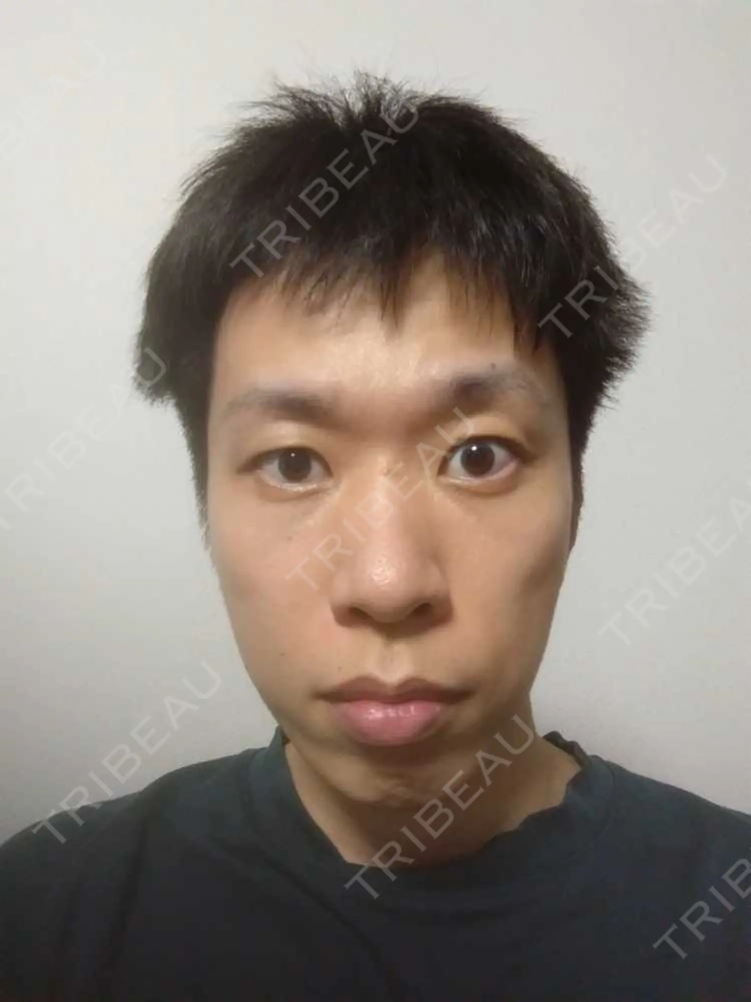 施術後の写真