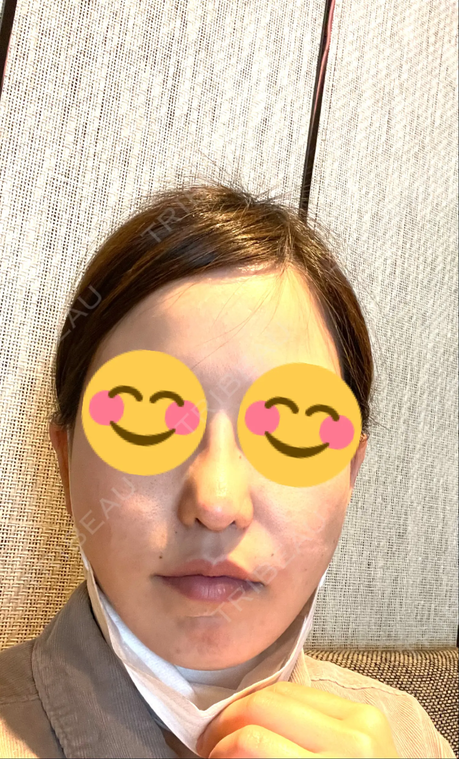 施術後の写真
