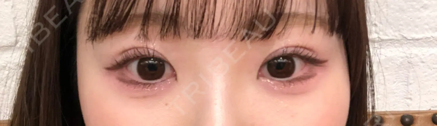 施術後の写真