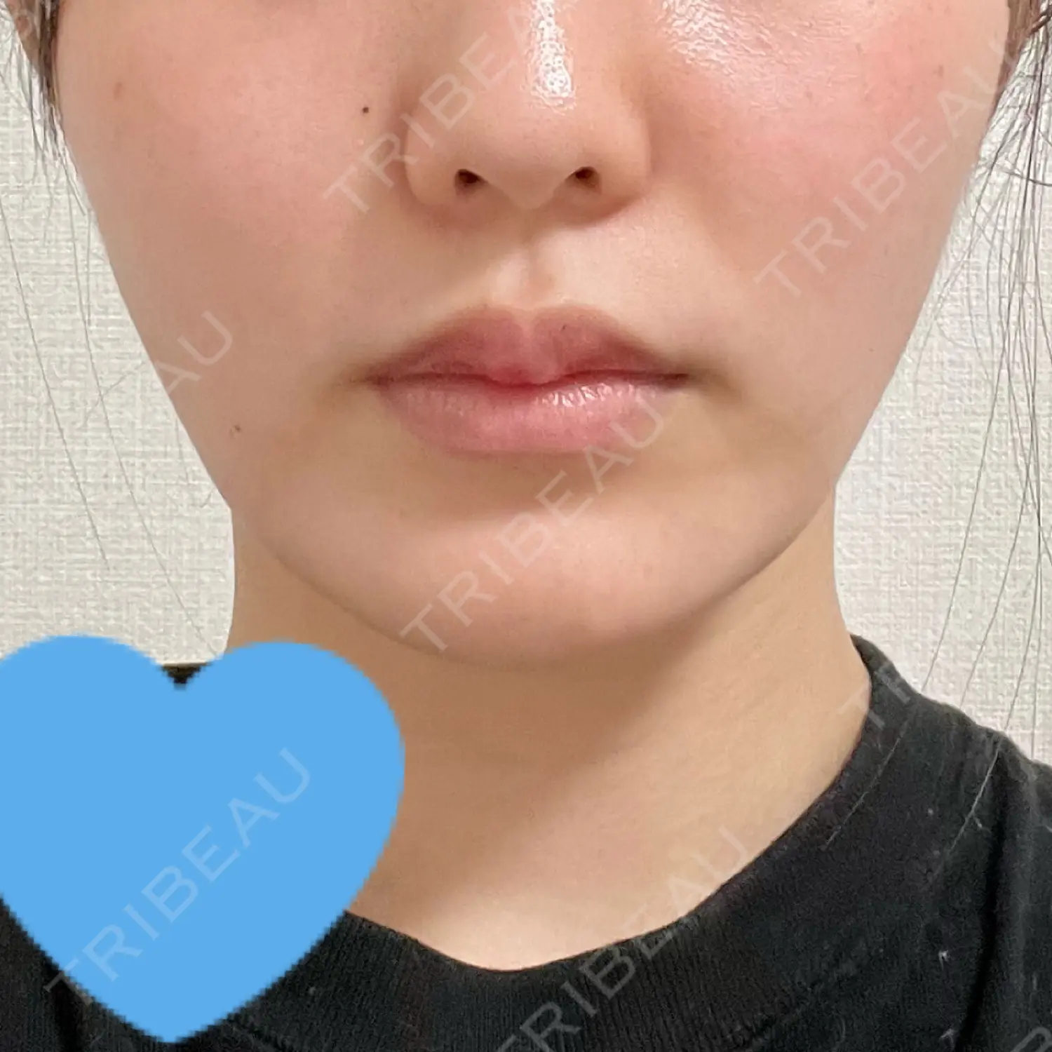 施術後の写真