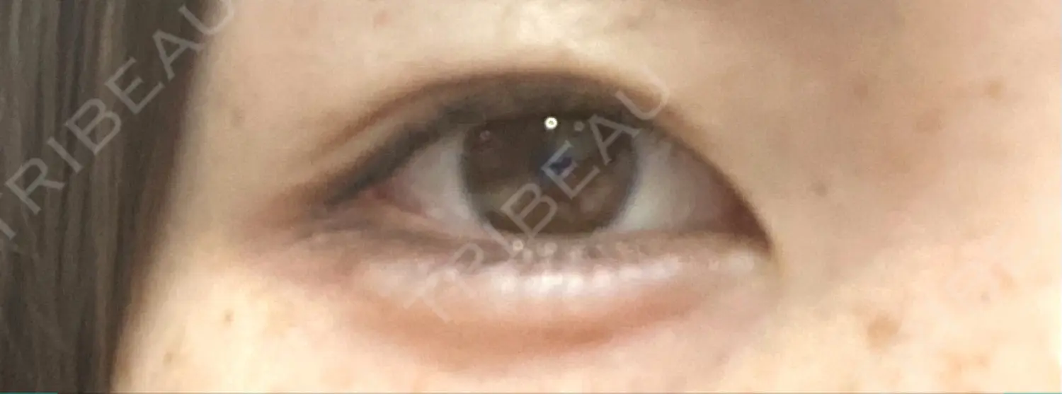 施術後の写真