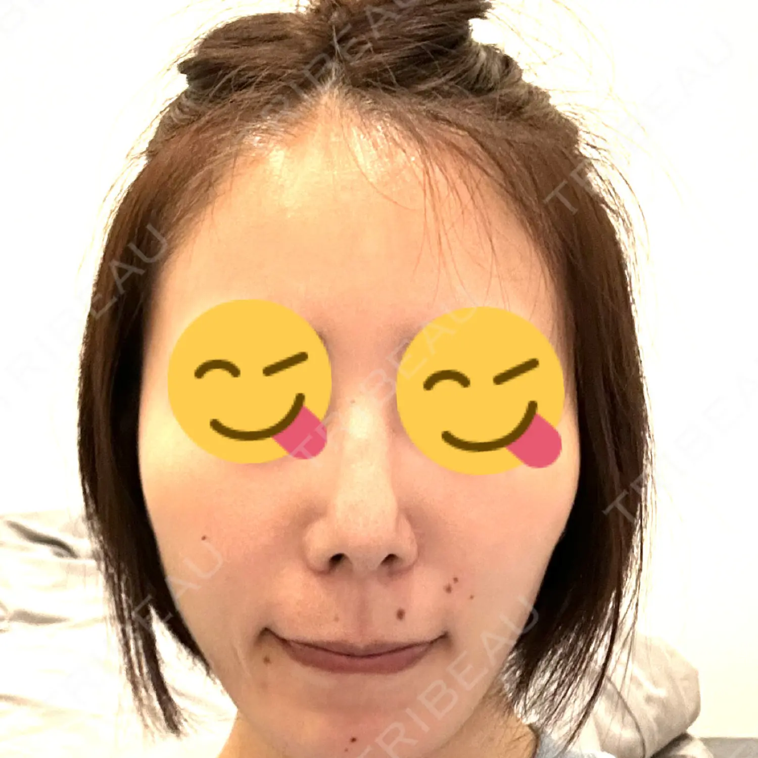 施術後の写真
