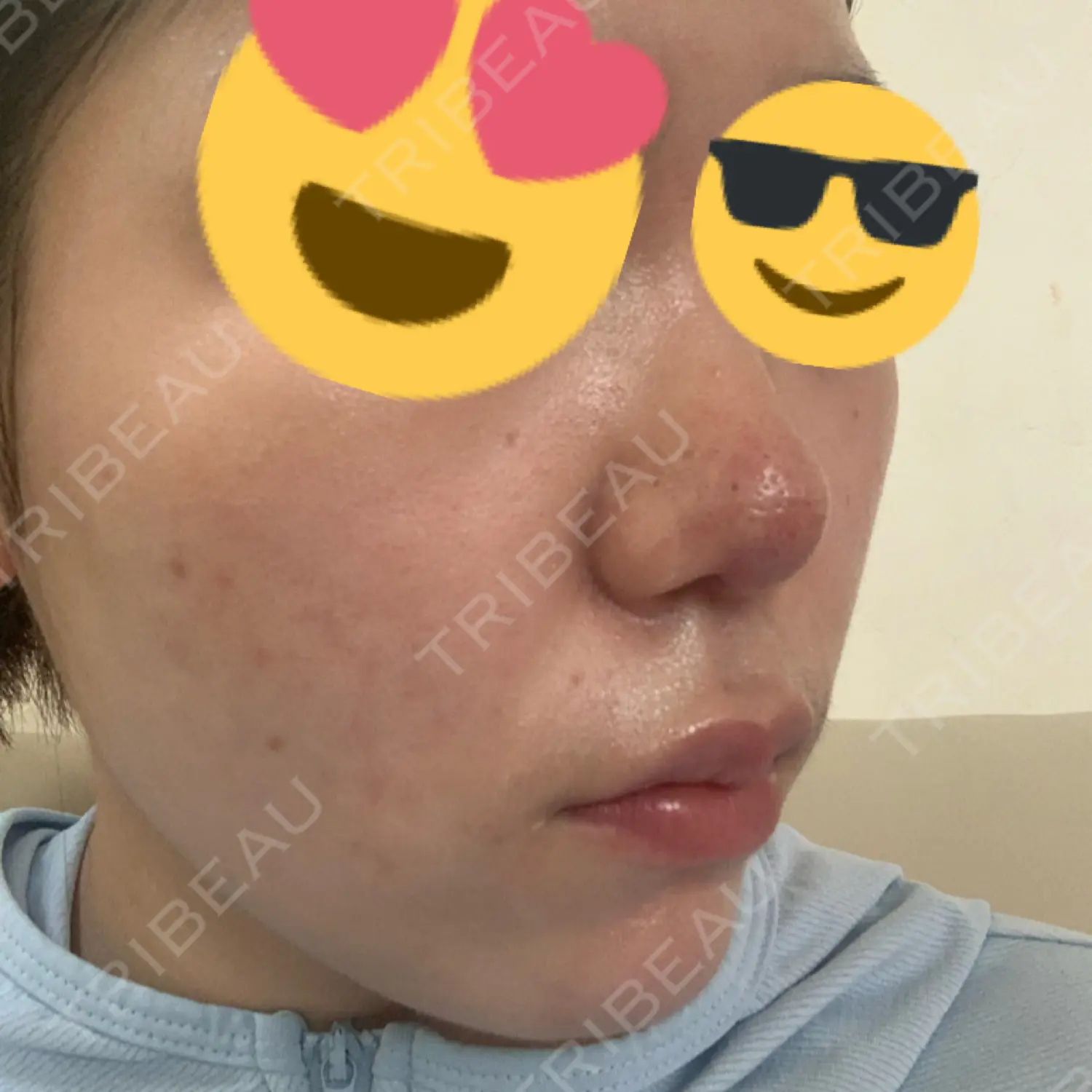 施術後の写真