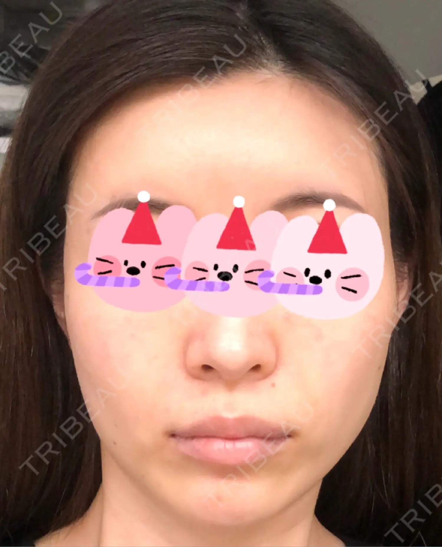 施術後の写真