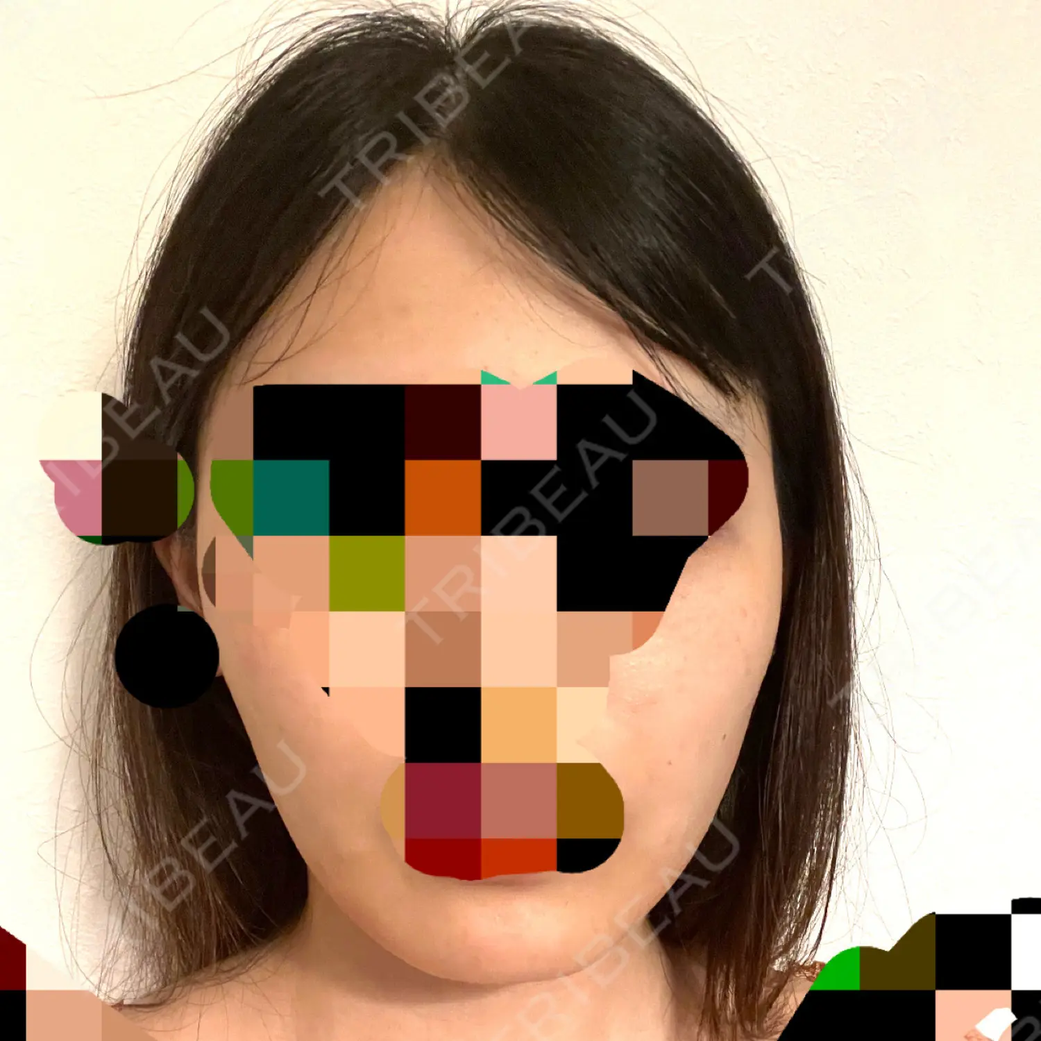 施術後の写真