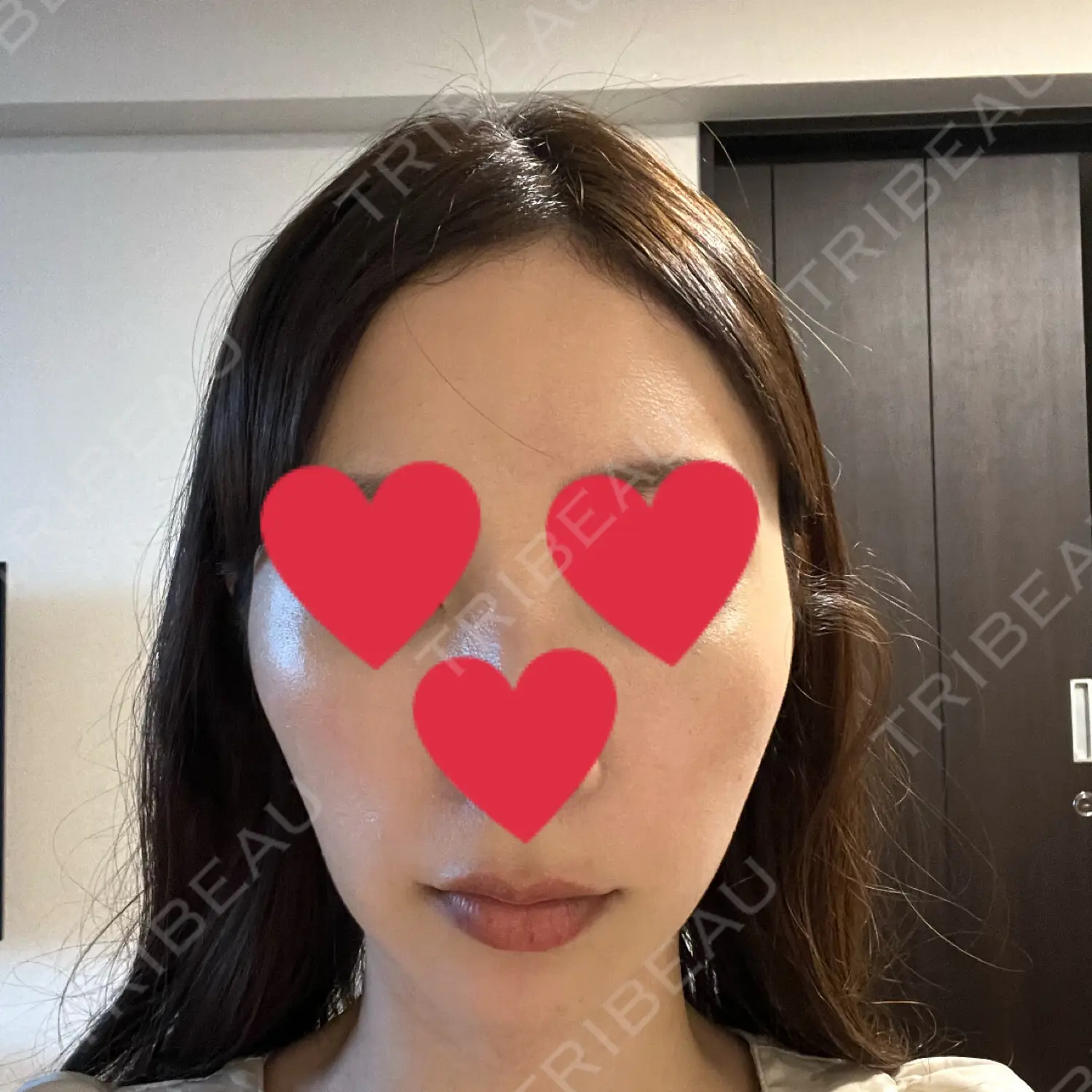 施術後の写真