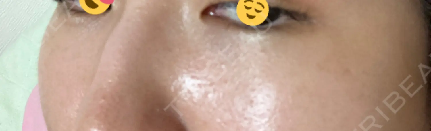 施術後の写真