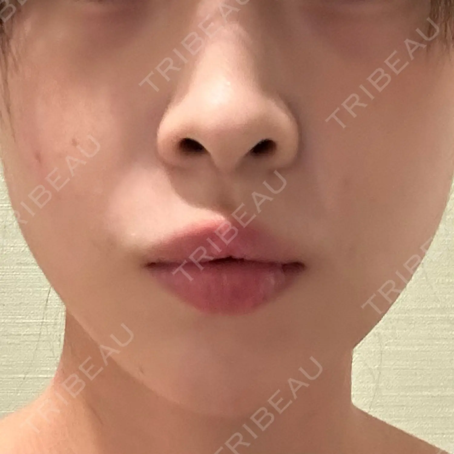 施術後の写真