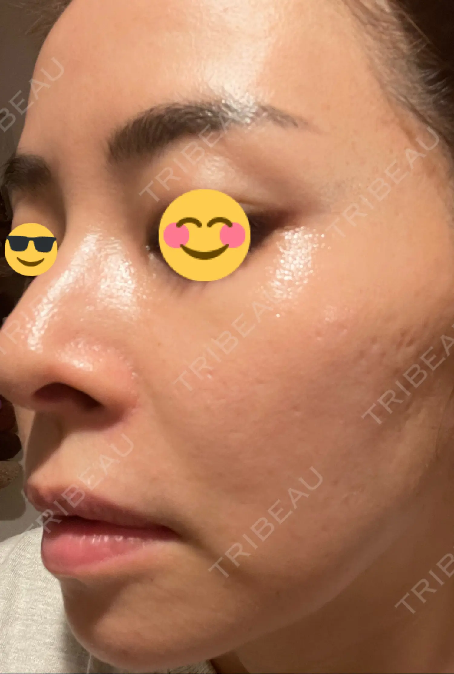 施術後の写真